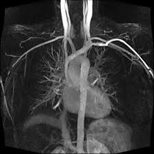 MRI Spine Scan